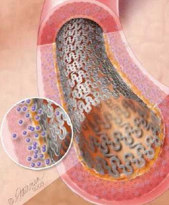 Установка стента в сосуды сердца (стентирование). Последствия, реабилитация, цена