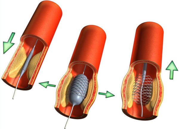 Установка стента в сосуды сердца (стентирование). Последствия, реабилитация, цена