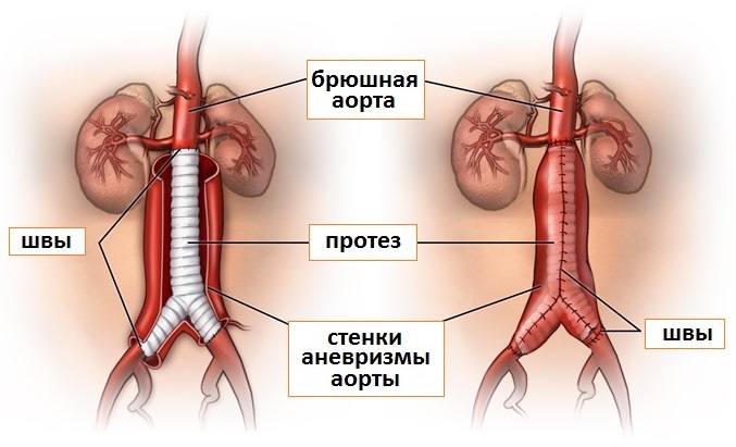 Ветви брюшной аорты. Схема, анатомия париетальных, непарных висцеральных. Атлас