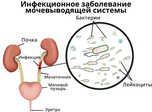 Воспаление мочевыводящих путей у женщин. Симптомы, лечение народными средствами, лекарства