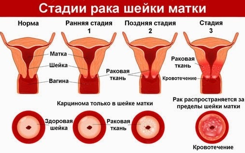 Заболевания шейки матки. Список, классификация, клинические рекомендации