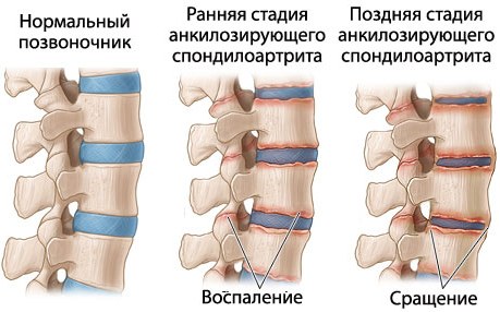 Анкилозирующий спондилит. Что это такое, клинические рекомендации, лечение