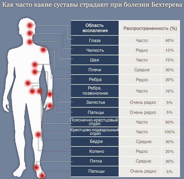 Анкилозирующий спондилит. Что это такое, клинические рекомендации, лечение