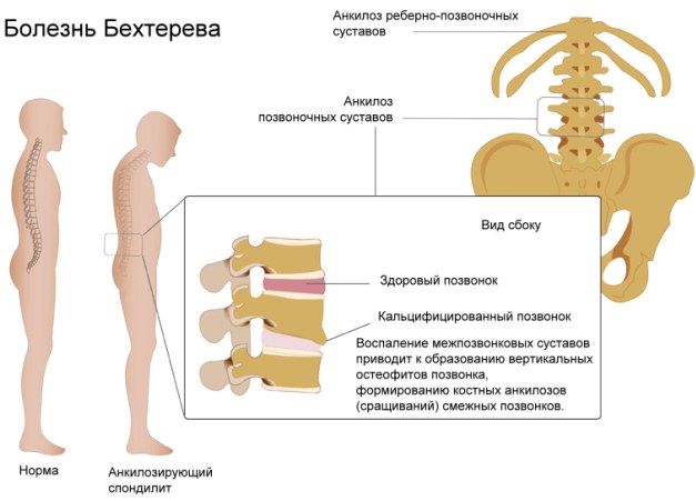 Анкилозирующий спондилит. Что это такое, клинические рекомендации, лечение