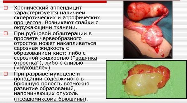 Аппендэктомия по Волковичу-Дьяконову параректальным разрезом по Ленандеру