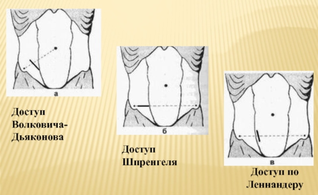Аппендэктомия по Волковичу-Дьяконову параректальным разрезом по Ленандеру