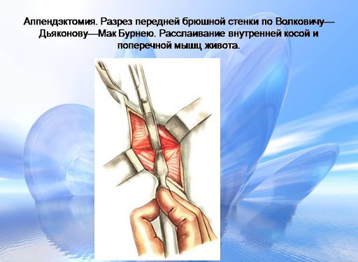 Аппендэктомия по Волковичу-Дьяконову параректальным разрезом по Ленандеру