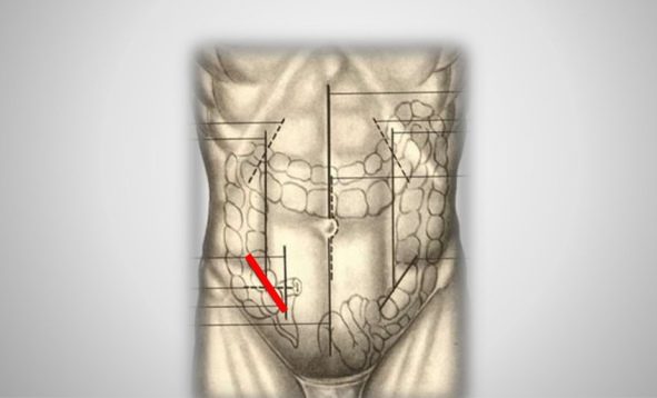 Аппендэктомия по Волковичу-Дьяконову параректальным разрезом по Ленандеру