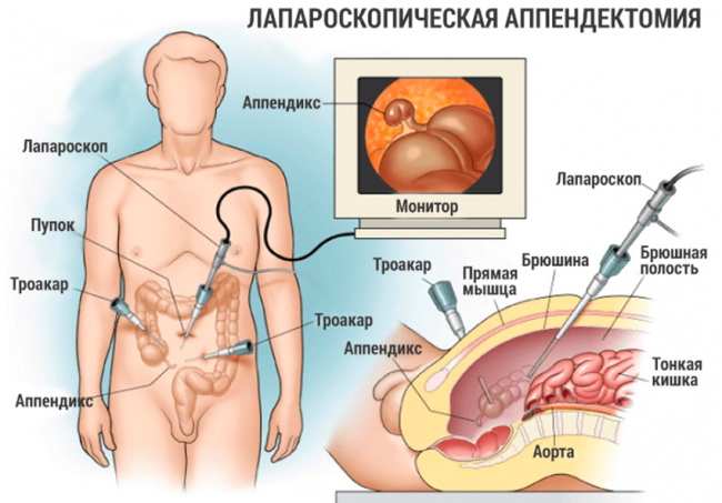 Аппендэктомия по Волковичу-Дьяконову параректальным разрезом по Ленандеру