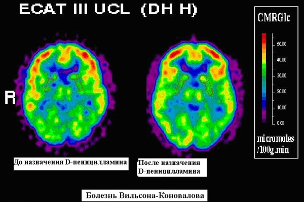 Картинки болезнь вильсона коновалова