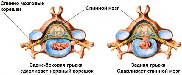Боли при грыже позвоночника в спине, ноге. Как избавиться, лечение
