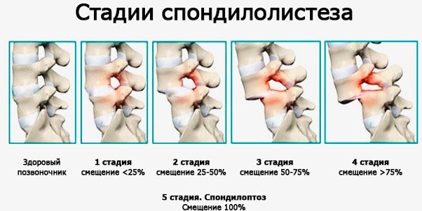 Болит спина ниже поясницы. Причины у женщин справа, слева, лечение