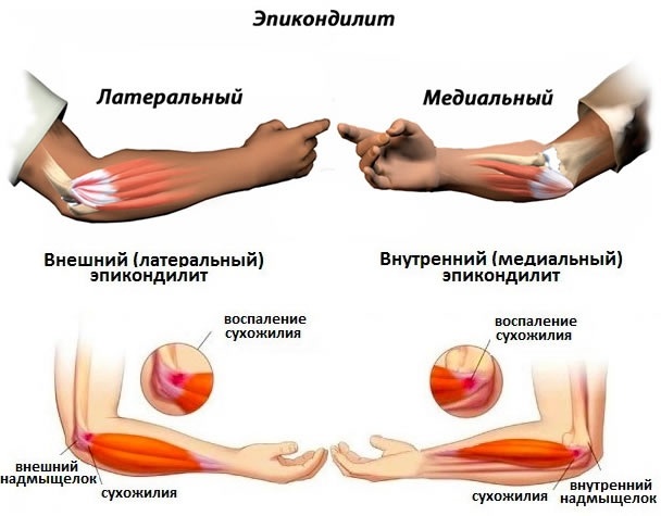 Болят локти рук. Причины и лечение