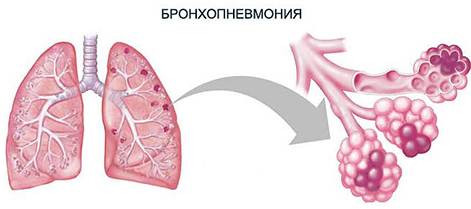 Бронхопневмония у взрослых. Симптомы, что это такое, лечение