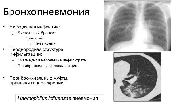 Бронхопневмония у взрослых. Симптомы, что это такое, лечение