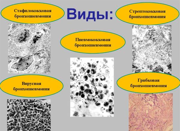 Бронхопневмония у взрослых. Симптомы, что это такое, лечение