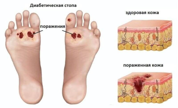 Диабетическая стопа. Лечение, препараты, мази, профилактика