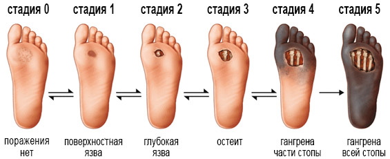 Синдром диабетической стопы картинки