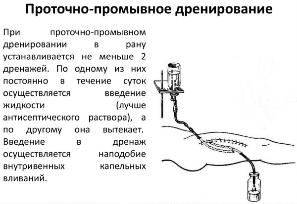 Дренажи в хирургии. Виды, назначение, характеристики