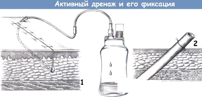 Дренажи в хирургии. Виды, назначение, характеристики