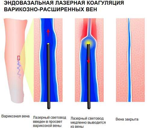 Эндовазальная лазерная коагуляция вен нижних конечностей. Осложнения, противопоказания