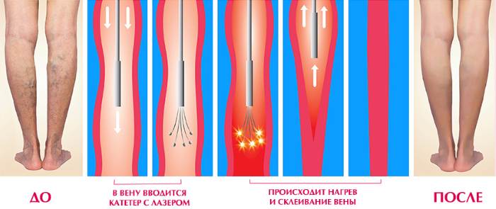 Эндовазальная лазерная коагуляция вен нижних конечностей. Осложнения, противопоказания