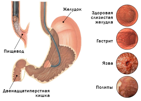 Непроходимость желудка. Симптомы и лечение у взрослых