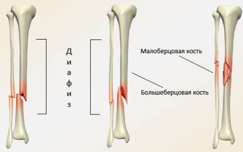 Голень ноги человека. Фото, схема расположения, мышцы, кости