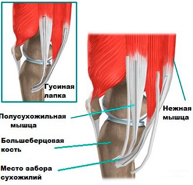 Гусиная лапка коленного сустава. Что это такое, анатомия, лечение
