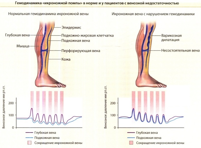 Хроническая венозная недостаточность. Классификация, лечение, степени