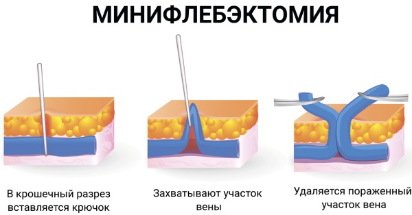 Хроническая венозная недостаточность. Классификация, лечение, степени