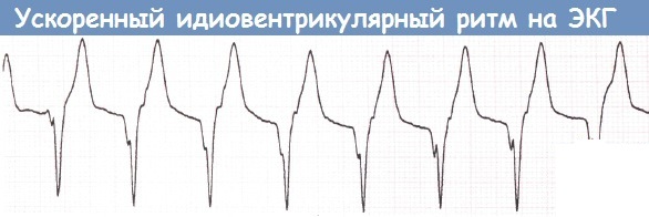 Субэндокардиальная ишемия на экг фото