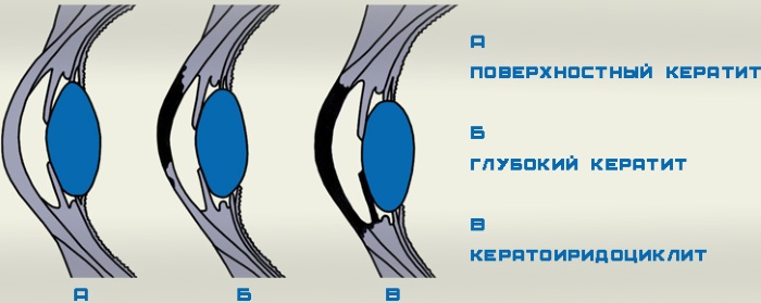 Кератиты. Классификация, диагностика, лечение, симптомы