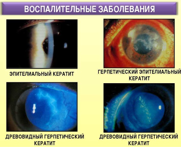 Кератиты. Классификация, диагностика, лечение, симптомы