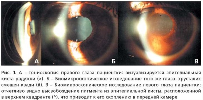 Кератиты. Классификация, диагностика, лечение, симптомы