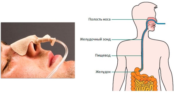 Кормление через назогастральный зонд. Алгоритм, показания, противопоказания