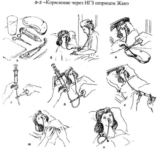 Кормление через назогастральный зонд. Алгоритм, показания, противопоказания