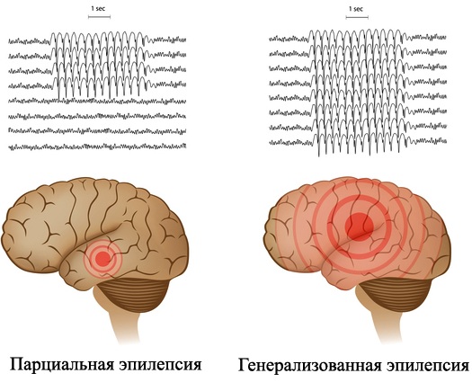 Купирование эпилептического статуса. Средства, клинические рекомендации