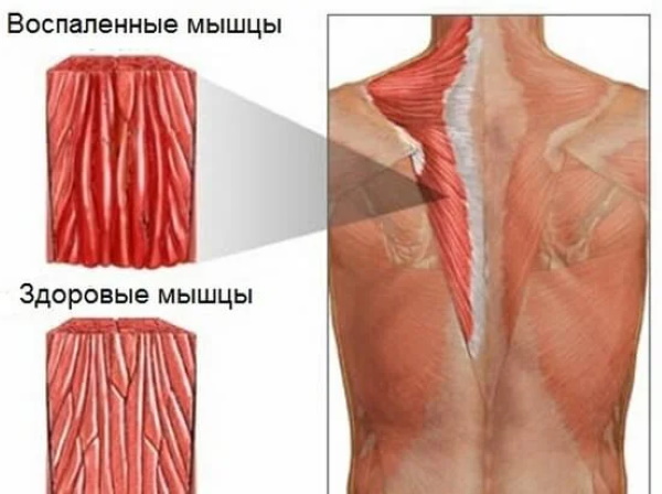 Мышечная боль во всем теле. Причины и лечение