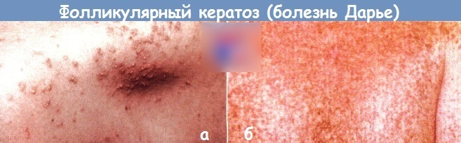 Недостаток витамина А в организме. Что вызывает, симптомы, болезни, как восполнить