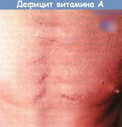 Недостаток витамина А в организме. Что вызывает, симптомы, болезни, как восполнить