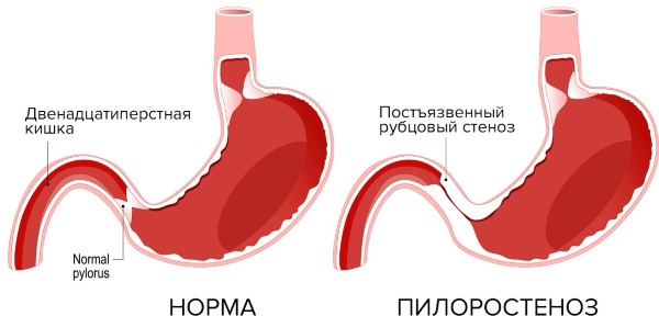 Непроходимость желудка. Симптомы и лечение у взрослых