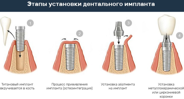 Импланты Nobel Biocare. Производитель, цена под ключ, отзывы