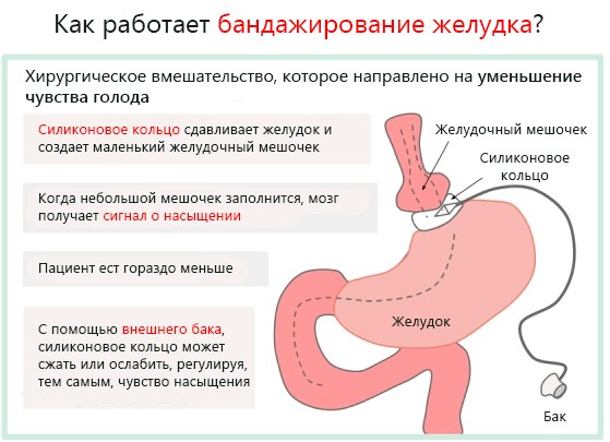 Ожирение 3 степени у женщин. Лечение, диета, препараты