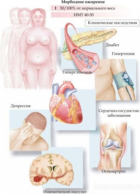 Ожирение 3 степени у женщин. Лечение, диета, препараты