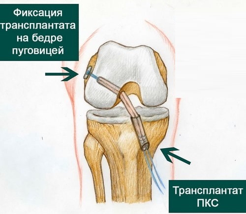 Передняя крестообразная связка. Анатомия, разрыв, повреждение, изменения, лечение