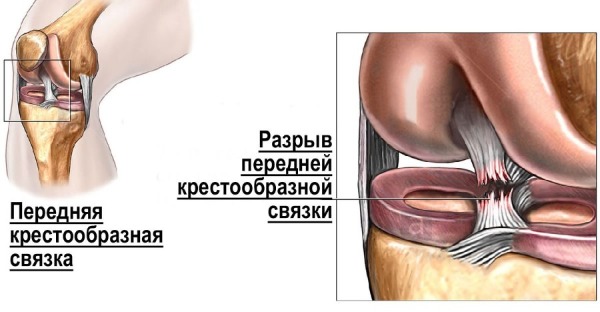 Передняя крестообразная связка. Анатомия, разрыв, повреждение, изменения, лечение