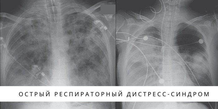 Респираторный дистресс-синдром (РДС) у взрослых, новорожденных, этиология, патогенез, клинические рекомендации