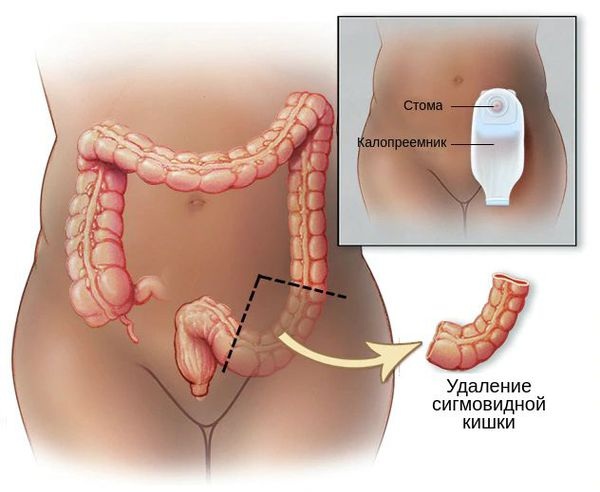 Сигмоидит. Симптомы и лечение у женщин, что это такое, диета