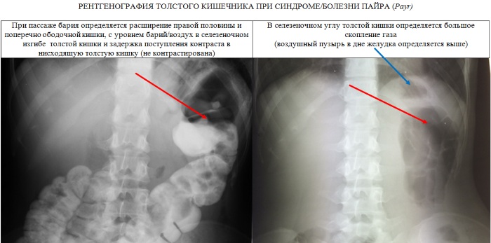 Синдром (болезнь) Пайра у взрослых. Что это такое, лечение не оперативно